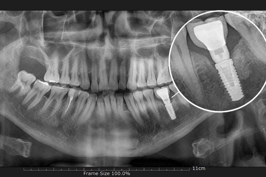 radiografia impianto dentale in titanio